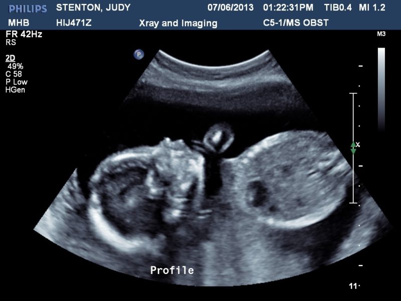 baby ultrasound heartbeat